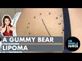 A Gummy Bear Lipoma