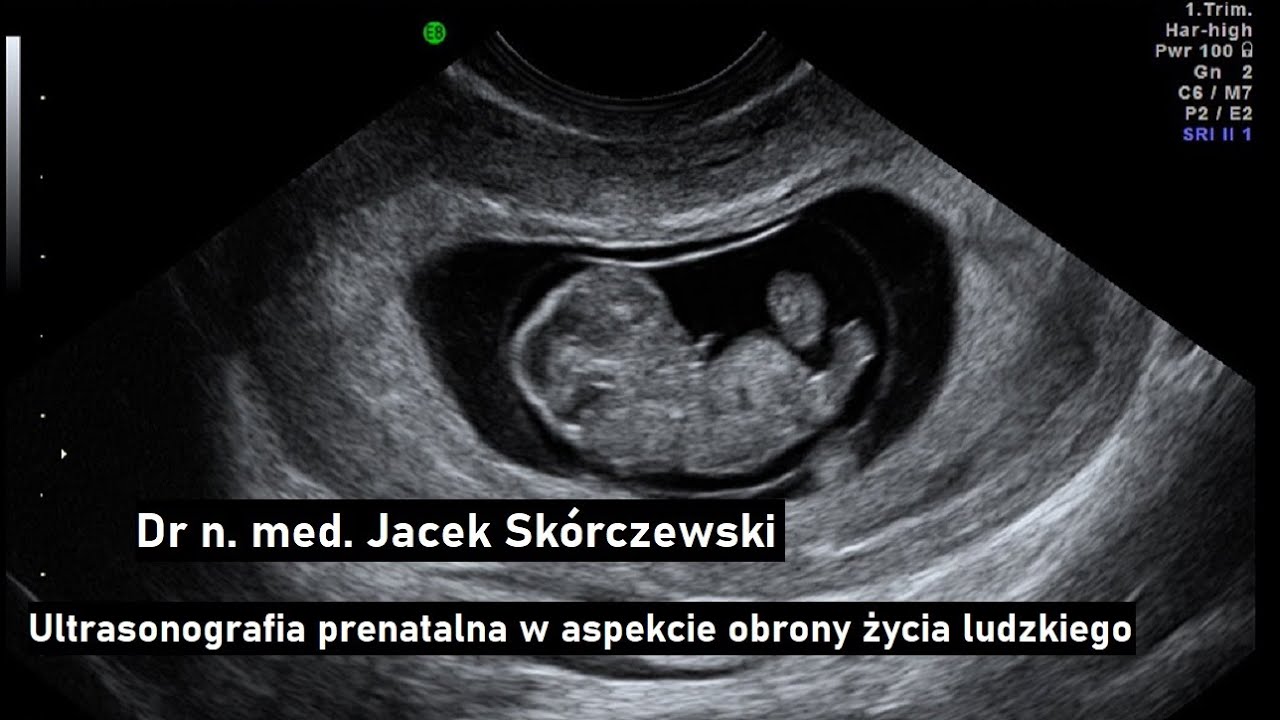 Dr n. med. Jacek Skórczewski - Ultrasonografia prenatalna w aspekcie obrony życia ludzkiego telewizjada pl