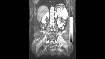 High resolution diffusion weighted imaging of the abdomen and pelvis MRI in 3 Tesla.
