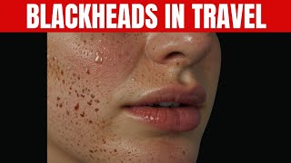 Preventing Blackheads While Traveling: Skincare Tips | Physio Speaks #blackheads