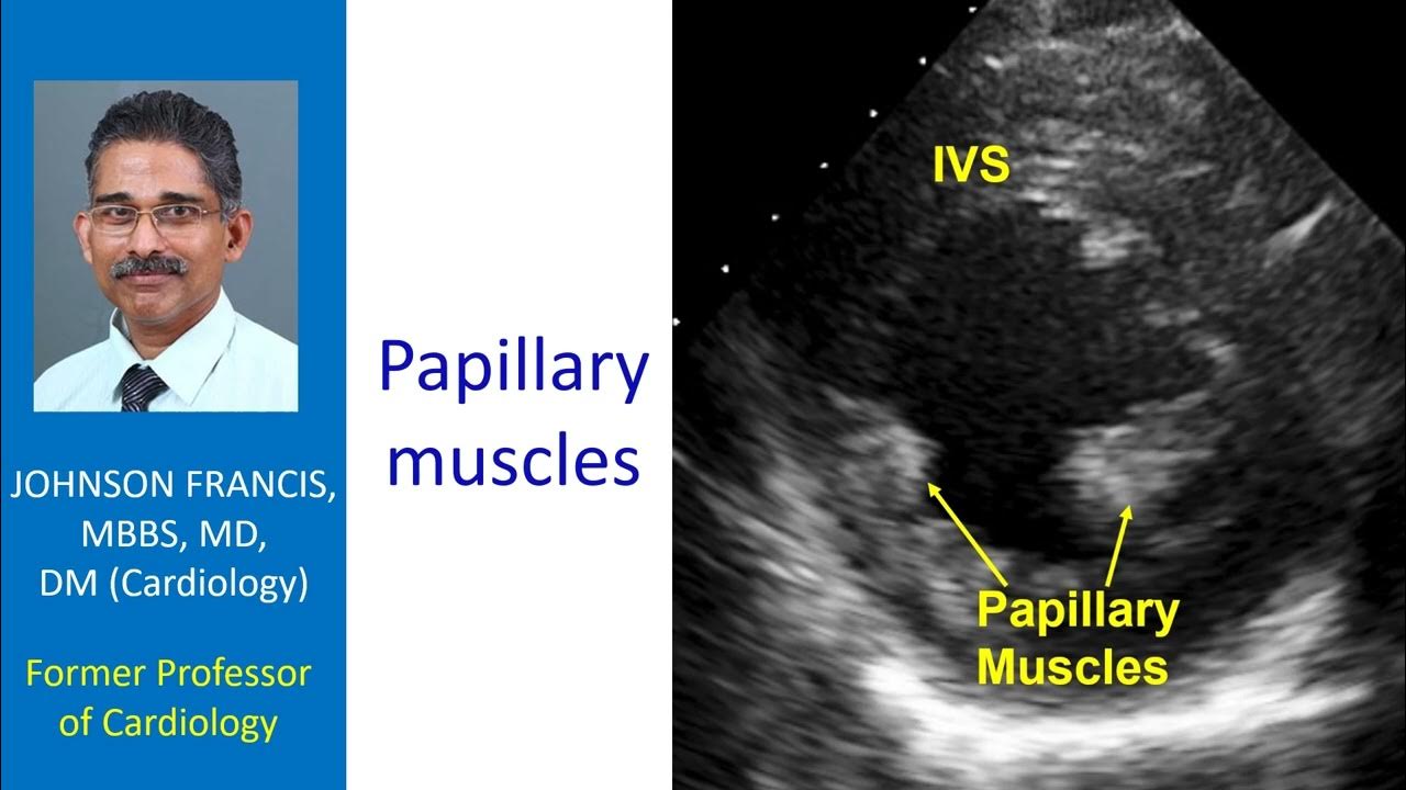 Papillary Muscles Echocardiogram YouTube papillary-muscles-echocardiogram-youtube