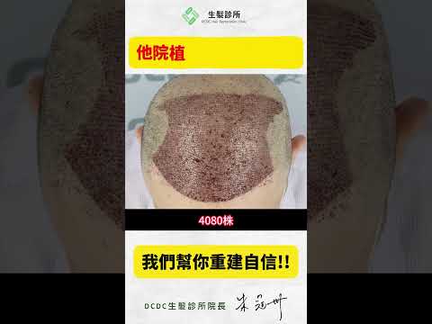 極限毛囊救援！DCDC讓每一根髮絲發揮最大價值！????????‍♂️