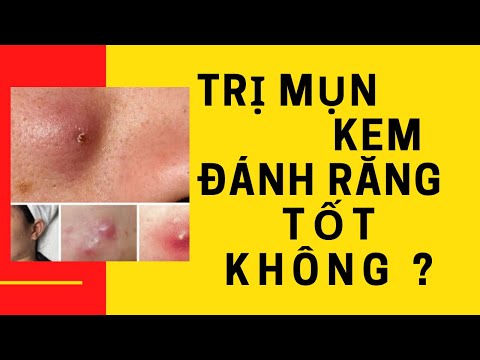 CÁCH TRỊ MỤN BẰNG KEM ĐÁNH RĂNG CÓ LỢI HAY CÓ HẠI ?