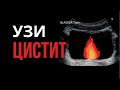 Цистит и УЗИ. Ультразвуковая картина некоторых видов острого и хронического цистита