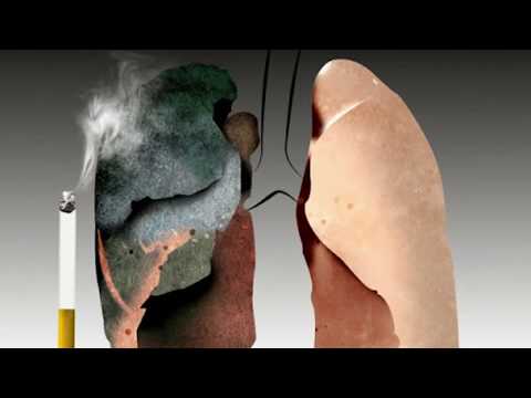 Video: Plămânii Fumătorilor Vs. Plămânii Sănătoși: Cunoașteți Diferența