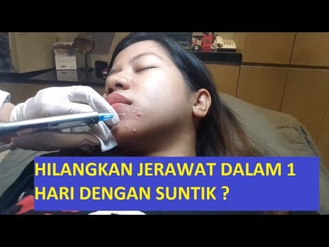 Video Suntik Jerawat Punggung