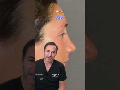 Video thumbnail: Nose Tip Rhinoplasty — Deprojecting the Tip — Albert Plastic Surgery New York