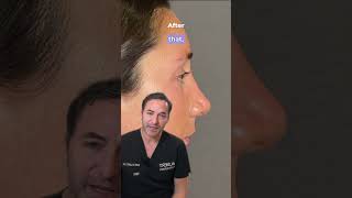 Nose Tip Rhinoplasty — Deprojecting the Tip