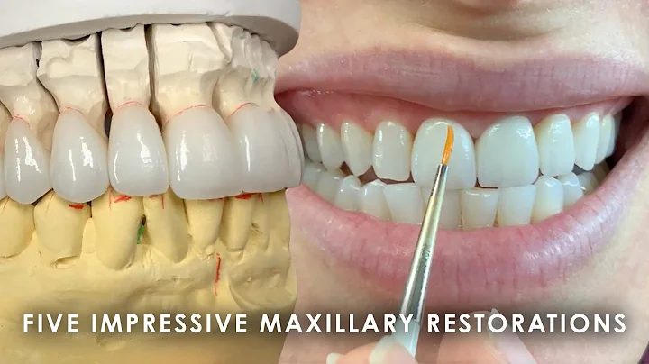 Five Impressive Maxillary Restorations