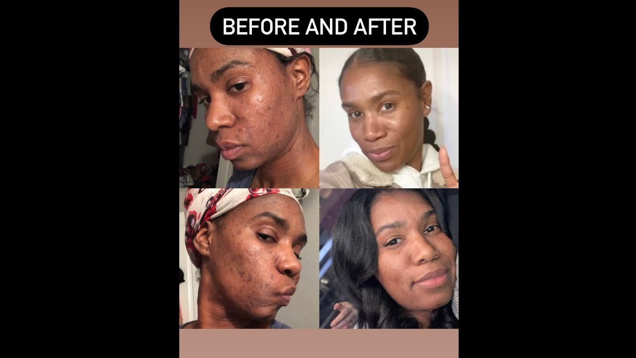 BEFORE AND AFTER HOW I CLEARED MY ACNE USING EARTHEN ESCAPES. ALL LOVE