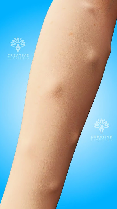 Why Do Lipomas Form Under Your Skin #shorts #viralvideo #lipomas - Creativelearning3d