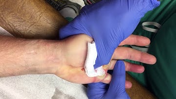 Dupuytrens contracture Xiaflex release procedure