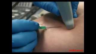 Венозный катетер под контролем УЗИ(Обучающее видео по введению венозного катетера под контролем ультразвука., 2012-08-29T14:55:37.000Z)