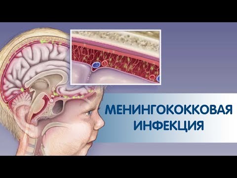 Бейне: Менингококк инфекциясы септикалық шокты қалай тудырады?