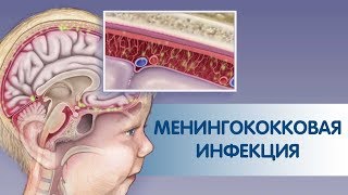 МЕНИНГОКОККОВАЯ ИНФЕКЦИЯ