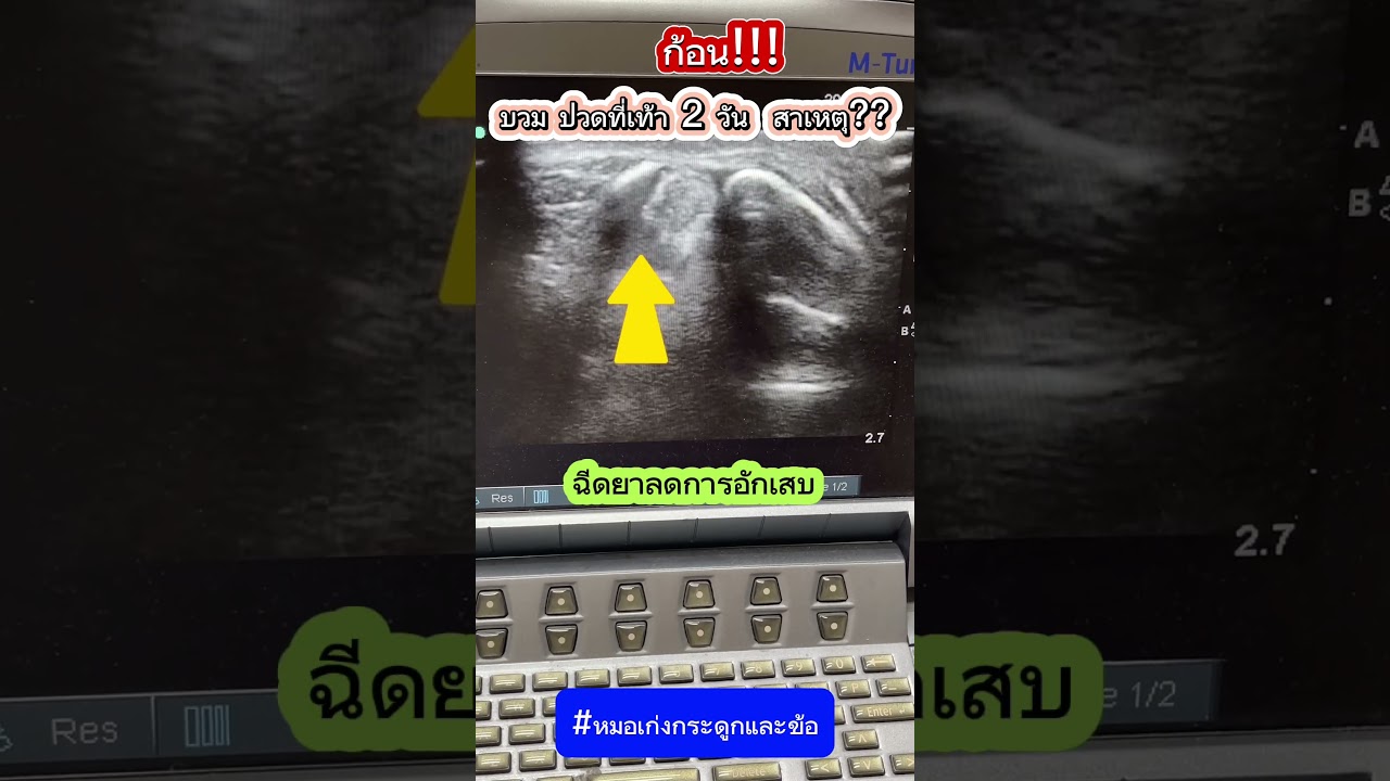 ก้อน ปวดบวมที่เท้ามา 2 วัน #หมอเก่งกระดูกและข้อ #ก้อนที่เท้า #ปวดเท้า #เท้าบวม