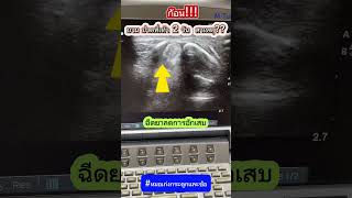 ก้อน ปวดบวมที่เท้ามา 2 วัน #หมอเก่งกระดูกและข้อ #ก้อนที่เท้า #ปวดเท้า #เท้าบวม