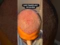 Hair transplant surgery before& after , hair transplant cost