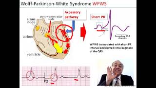 ECG Quick Review [Part 3]  #internal_medicine #cme #medicaleducation #ecg # محاضرات_باطنة screenshot 4