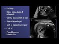 TMT: Echogenic Lungs | Dr Alpana Joshi | CCAM | Pulmonary Sequestration | CPAM | Fetal Medicine