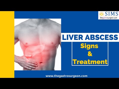 Best treatment for Liver Abscess |Liver abscess signs and treatment | Liver abscess |