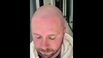 Natural Receding Hairline restoration with Scalp Micro Pigmentation