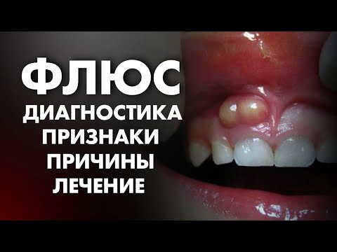 ФЛЮС: ПРИЗНАКИ, ПРИЧИНЫ, ДИАГНОСТИКА, ЛЕЧЕНИЕ ПЕРИОСТИТА | Клиника Online