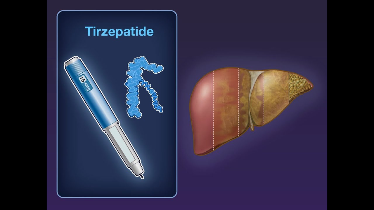 does tirzepatide help with fatty liver Tirzepatide for MASH with Liver Fibrosis