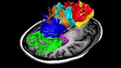 Tractography