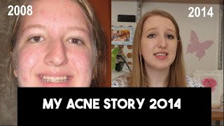 Acne Story: How I naturally cleared my acne + Tips and Tricks