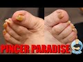 TRIMMING OF SUPER CURVED PINCER TOENAILS