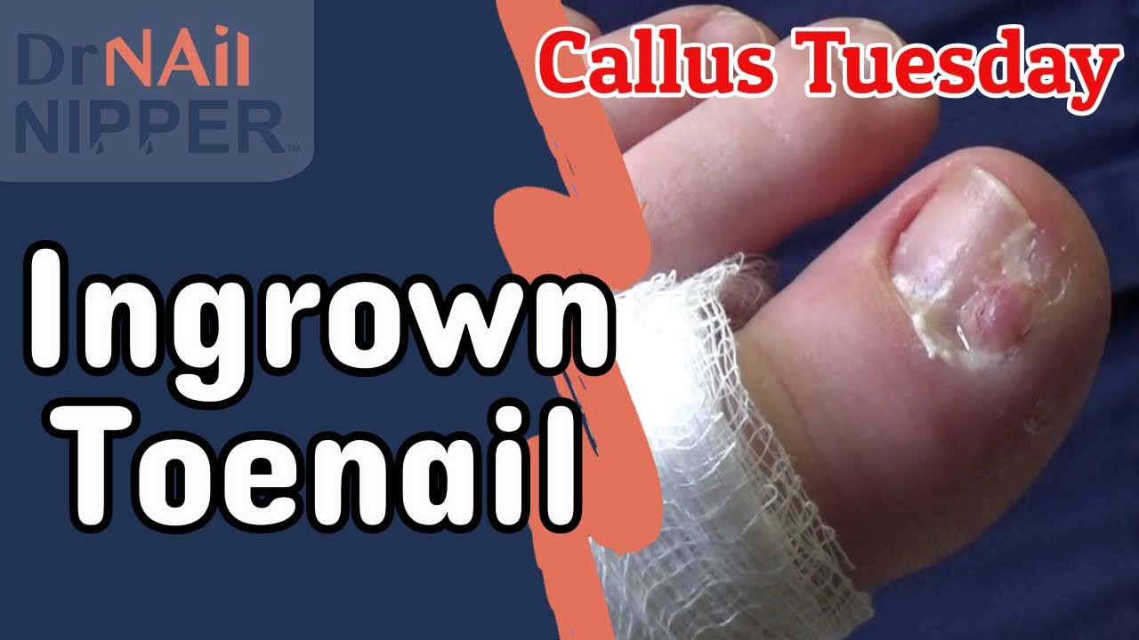 Ingrown Toenail for Callus Tuesday (2020) YouTube