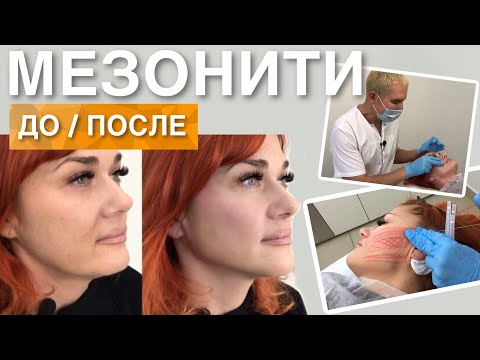 МЕЗОНИТИ ДО и ПОСЛЕ | Ставим Нити COG, профилактика старения лица #мезонити #подтяжкалица