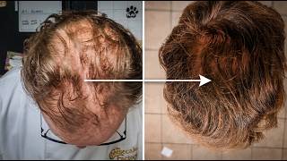 He Was Going Bald. 1 Year Later His Crown Was Full.