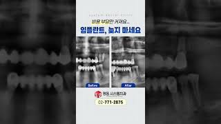 어금니 없이 방치하다 전체 임플란트를 해야 하는 상황... 비용 부담으로 우측만 진행하셨습니다ㅠ [명동 시스템치과]