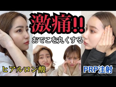 超激痛 おでこを簡単に丸くする整形 ヒアルロン酸注入 Prp注射 プルプル注射 Youtube