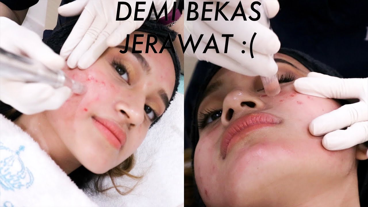 Vampire Facial Solusi Bopeng Bekas Jerawat Nadya Aqilla Youtube