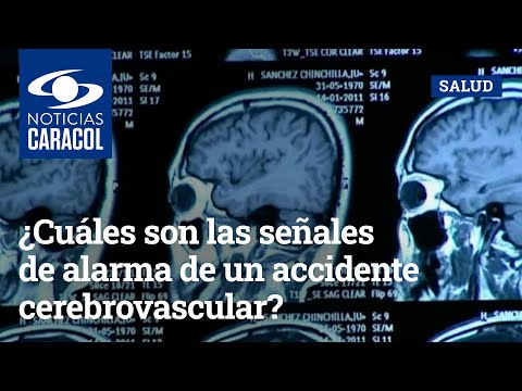 Video: 3 formas de reconocer las señales de advertencia de un accidente cerebrovascular