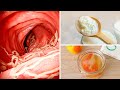 5 Foods That Kill Intestinal Worms Naturally