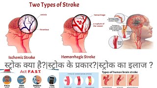 What is a stroke?Treatment of stroke?#stroke #paralysis