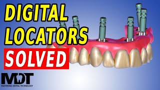 Fixed Locator Denture and NEW Digital Locator Library for ZEST Locators in Exocad 3.2 Fixed Locator Denture and NEW Digital Locator Library for ZEST Locators in Exocad 3.2