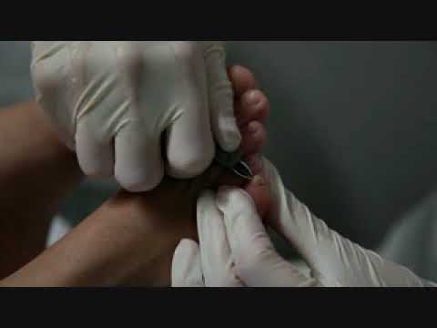Video: Hyponychium (pod Nechtom Kože) Príčiny Zahusťovania A Liečba