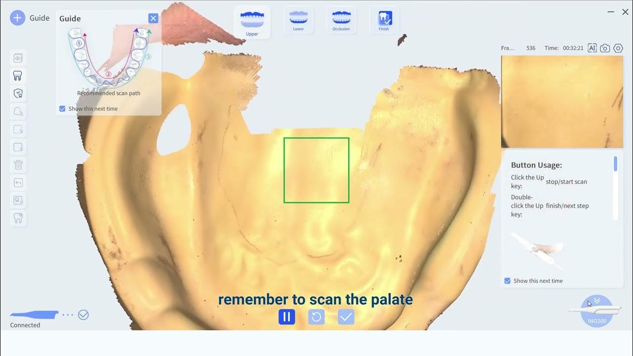 Intraoral Scanner Edentulous Scan Case Guidance YouTube