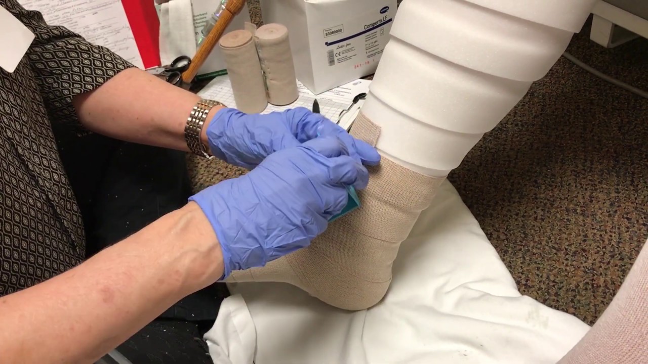 Lymphedema Therapy And Compression Wrapping Bandaging For Legs Youtube