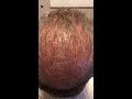 Beard FUE Hair Transplant in Dallas Immediately After