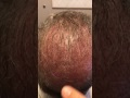 Beard FUE Hair Transplant in Dallas Immediately After