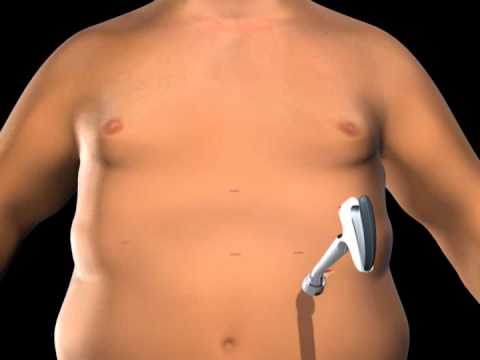Gastric Band - Video Explanation
