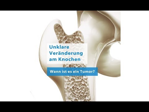 Video: Klinische Bedeutung Von Serumlöslichem B7-H3 Bei Patienten Mit Osteosarkom