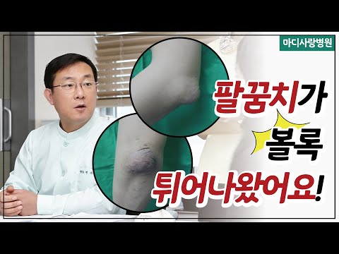 팔꿈치가 볼록 튀어나왔어요! 재발성 점액낭염이란 무엇일까요?