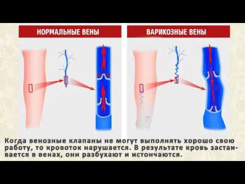 Самомассаж ног при варикозе